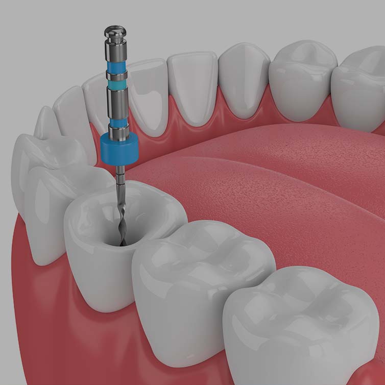 Treatment - Midsummer Dental
